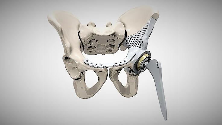 3D Printing of implantable medical devices - MTAA